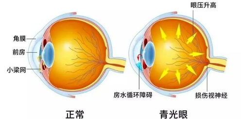不可逆的 視力小偷 ,我們應(yīng)該如何應(yīng)對(duì)ta